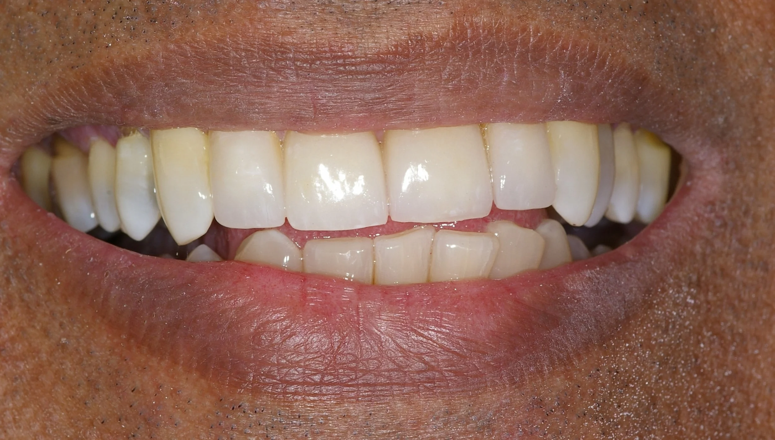 Smile Transformations — Andover Dental - Dennis Rothschild, DDS